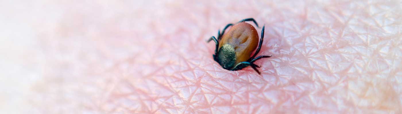Tick with its head stuck in human skin